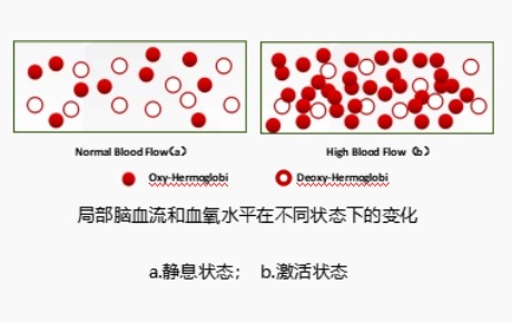 fNIRS研究表明：有/無自殺意念的抑郁癥個體在特定任務期間DLPFC激活不同
