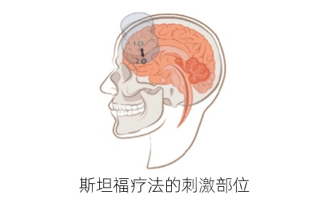 高質量文獻：多療程斯坦福療法（SNT）對重度抑郁癥復發(fā)后療效驗證